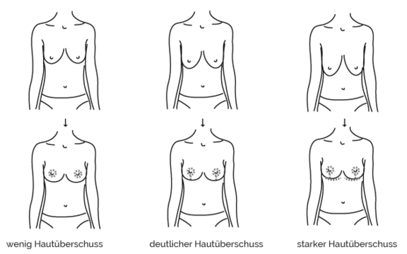 Bruststraffung, prevention-center für Ästhetische Chirurgie in Zürich & Zug, Dr. Christian Köhler