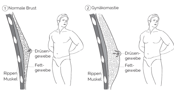 Gynäkomastie, prevention-center für Schönheitschirurgie in Zürich & Zug, Dr. Christian Köhler