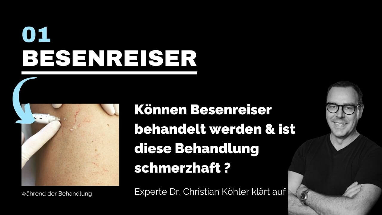 Besenreiser entfernen, prevention-center für Schönheitschirurgie in Zürich & Zug
